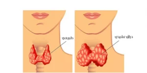 ماهو تضخم الغدة الدرقية